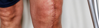 Rehabilitación tras una prótesis de rodilla: cómo la fisioterapia mejora tu calidad de vida