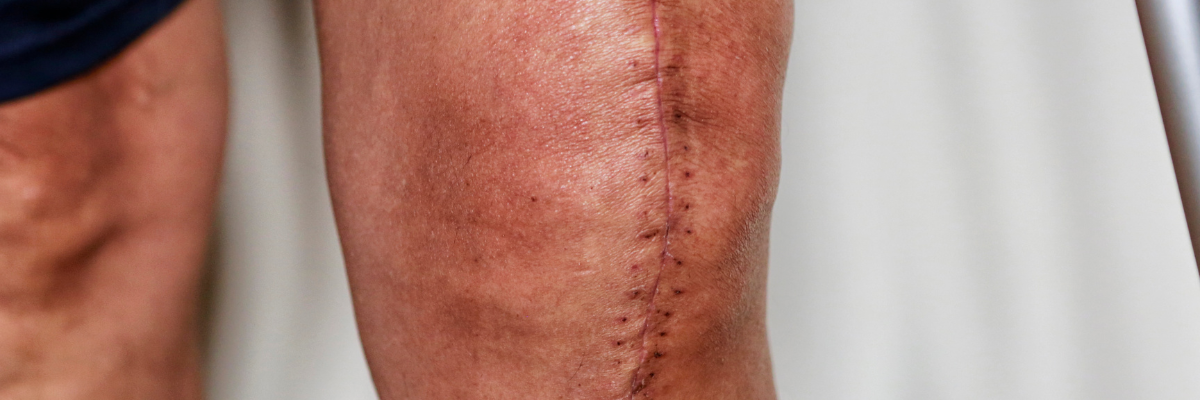 Fisioterapia para la recuperación de prótesis de rodilla y cadera