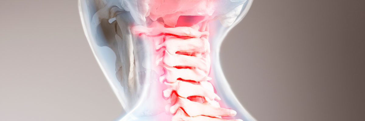 Tratamiento fisioterapéutico para el latigazo cervical tras un accidente de tráfico