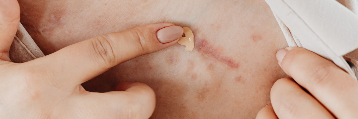 Radiofrecuencia Indiba para cicatrices y fibrosis: Recupera la elasticidad de tu piel