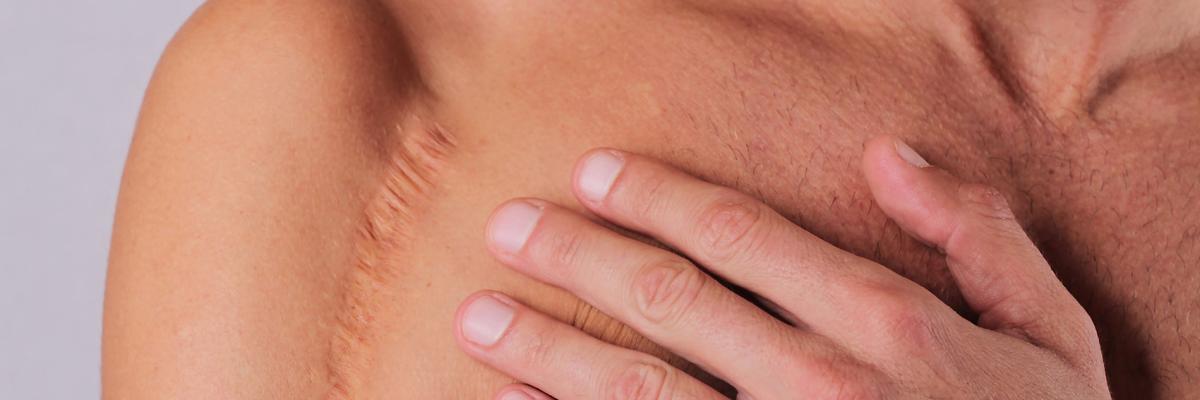 Fisioterapia fibrosis y adherencias