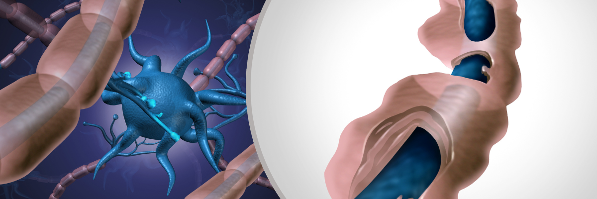 Fisioterapia para mejorar la movilidad en pacientes con esclerosis múltiple