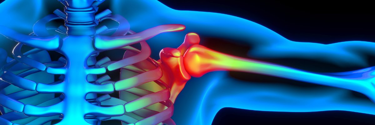 Cómo aliviar el dolor: fisioterapia para la tendinitis del hombro